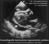 Ecocardiografía transtorácica (ETT) de un taponamiento cardíaco con colapso del ventrículo derecho